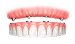 Dental Implant in Davie