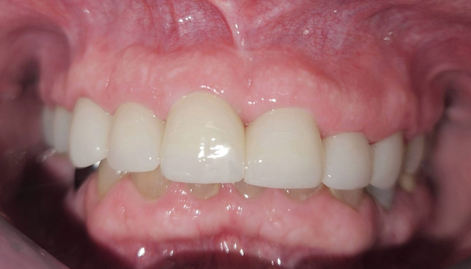 New crowns have a very natural look. Patient was VERY happy and said she would have to relearn how to smile.