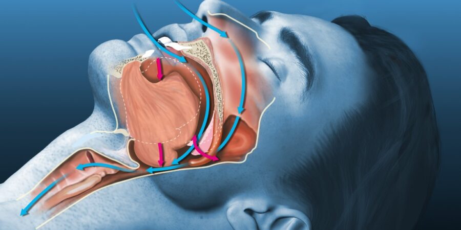 Illustration of the normal pathway of airflow in oral and nasal passages