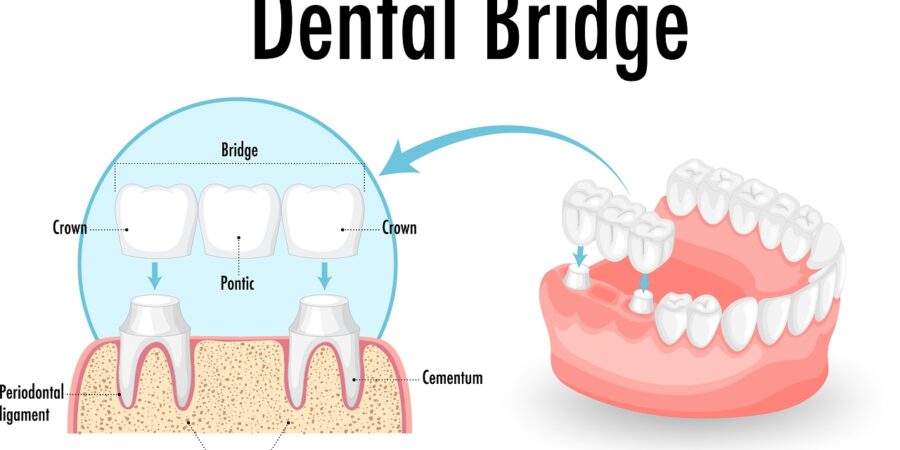 dental bridge illustration