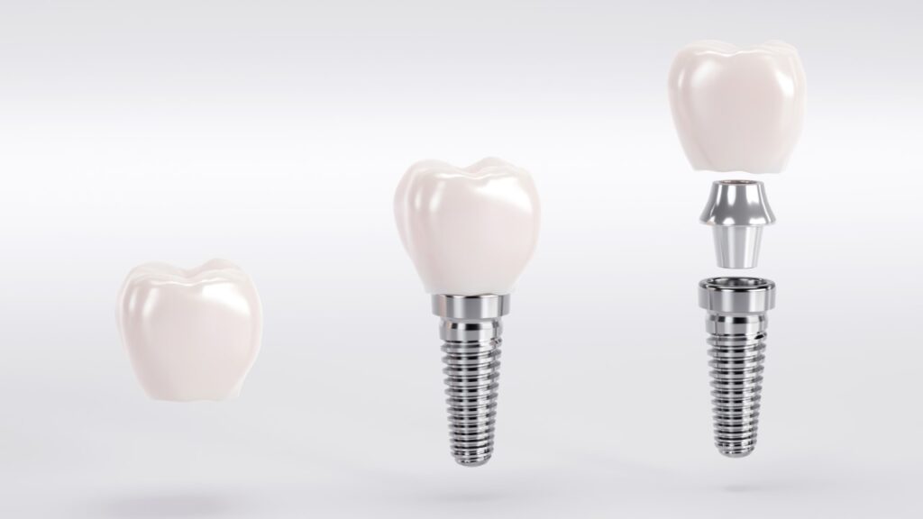 illustration of a crown on top of a dental implant